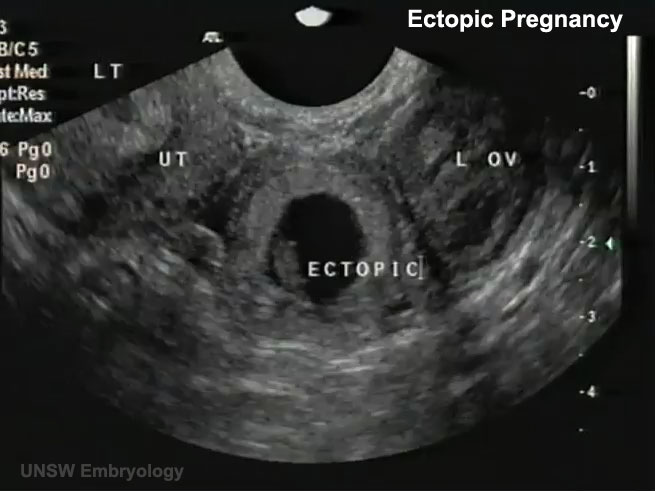 Transvaginalni ultrazvuk